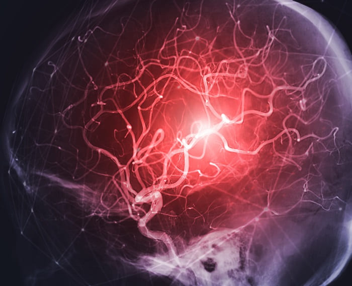 Imagen: La herramienta AI predice los resultados del accidente cerebrovascular después de la eliminación del coágulo arterial con una precisión del 78% (foto cortesía de Adobe Stock)